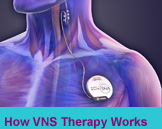 How VNS Therapy Works